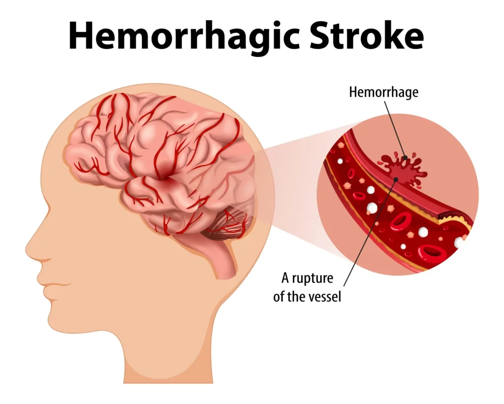 เส้นเลือดในสมองแตก หรือหลอดเลือดสมองแตก (Hemorrhagic Stroke) ผนังหลอดเลือดอ่อนแอ หรือเปราะบาง เกิดจากความดันโลหิตสูง ไขมันในเลือดสูง หรือปัจจัยอื่น ๆ เมื่อได้รับแรงดันเลือดสูงเกินไปก็จะเกิดการฉีกขาด เลือดที่ไหลก็จะไปกดทับเนื้อเยื่อสมอง ทำให้เซลล์สมองบริเวณนั้นขาดออกซิเจนและเสียหายในที่สุด 