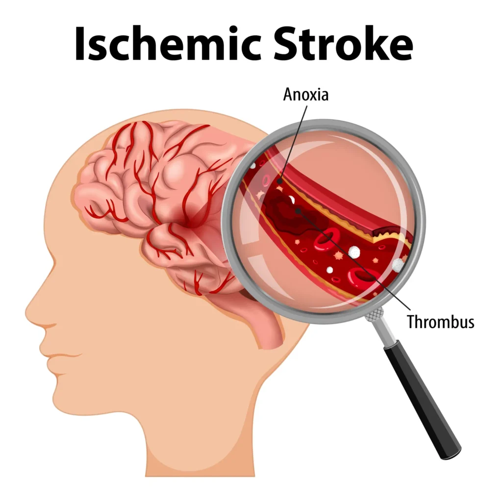 โรคเส้นเลือดในสมองตีบ เกิดจาก 2 สาเหตุหลัก ๆ คือ ภาวะหลอดเลือดแดงแข็ง (Atherosclerosis) และหลอดเลือดในสมองอุดตัน (Embolic) 